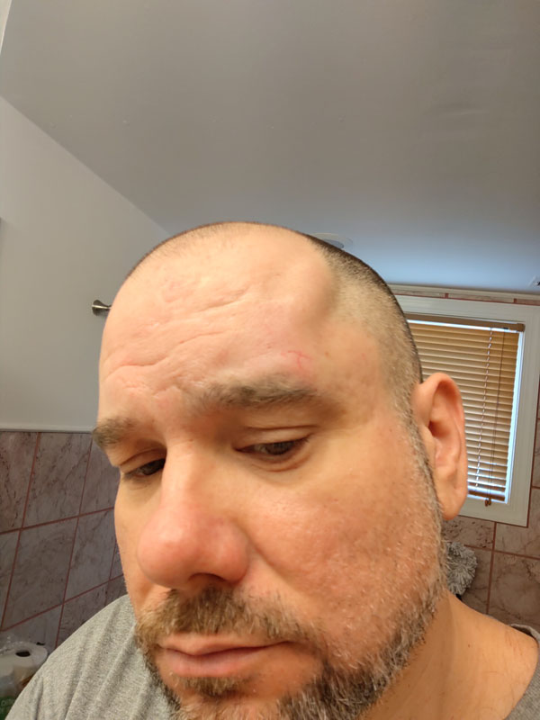 Inj-Pic-69